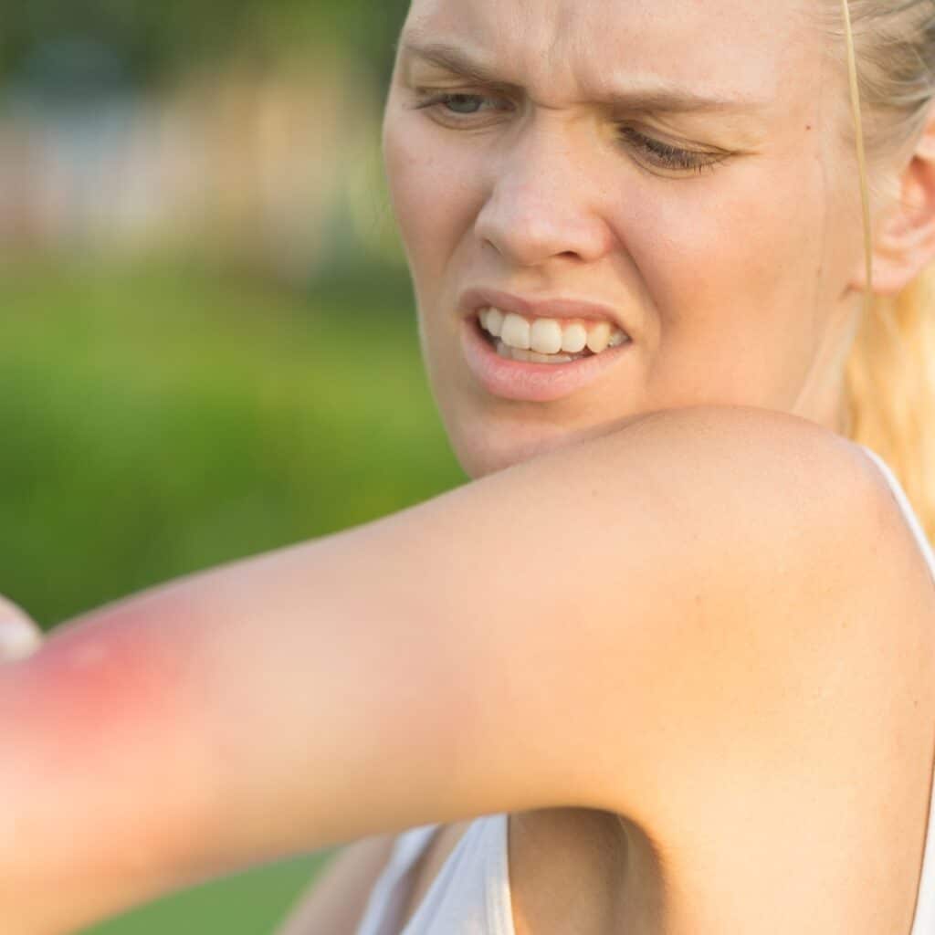 Piqûres de moustiques : une dermatologue donne son astuce efficace contre les démangeaisons