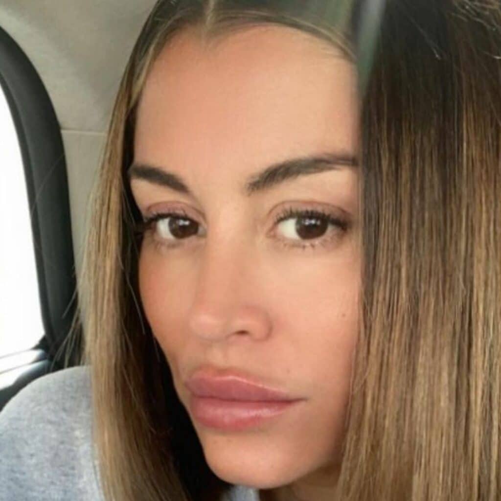 Anaïs Camizuli (Les Cinquante) : défigurée après une agression, elle montre son visage