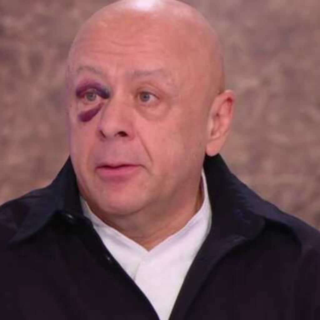 Thierry Marx : il apparaît avec un impressionnant œil au beurre noir et explique ce qu'il s'est passé