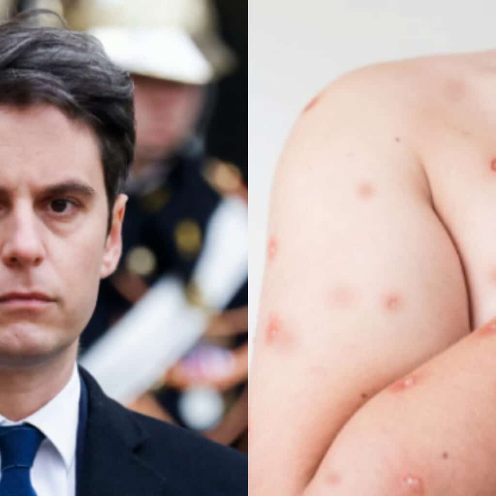 Variole du singe : le placement du système de santé en état de vigilance maximale est décrété par Gabriel Attal