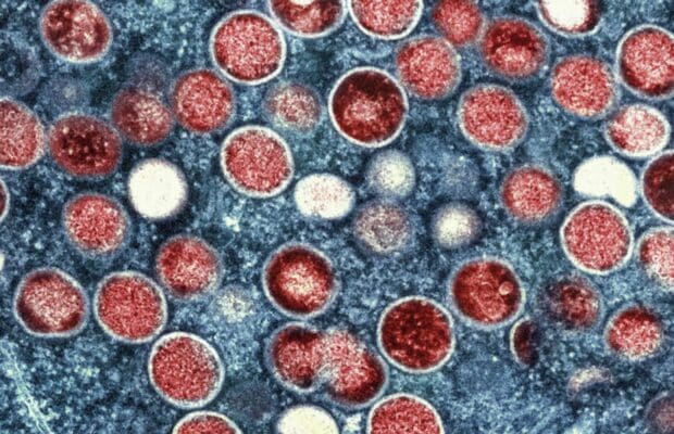 Variole du singe : le processus de transmission du "Clade lb" se précise