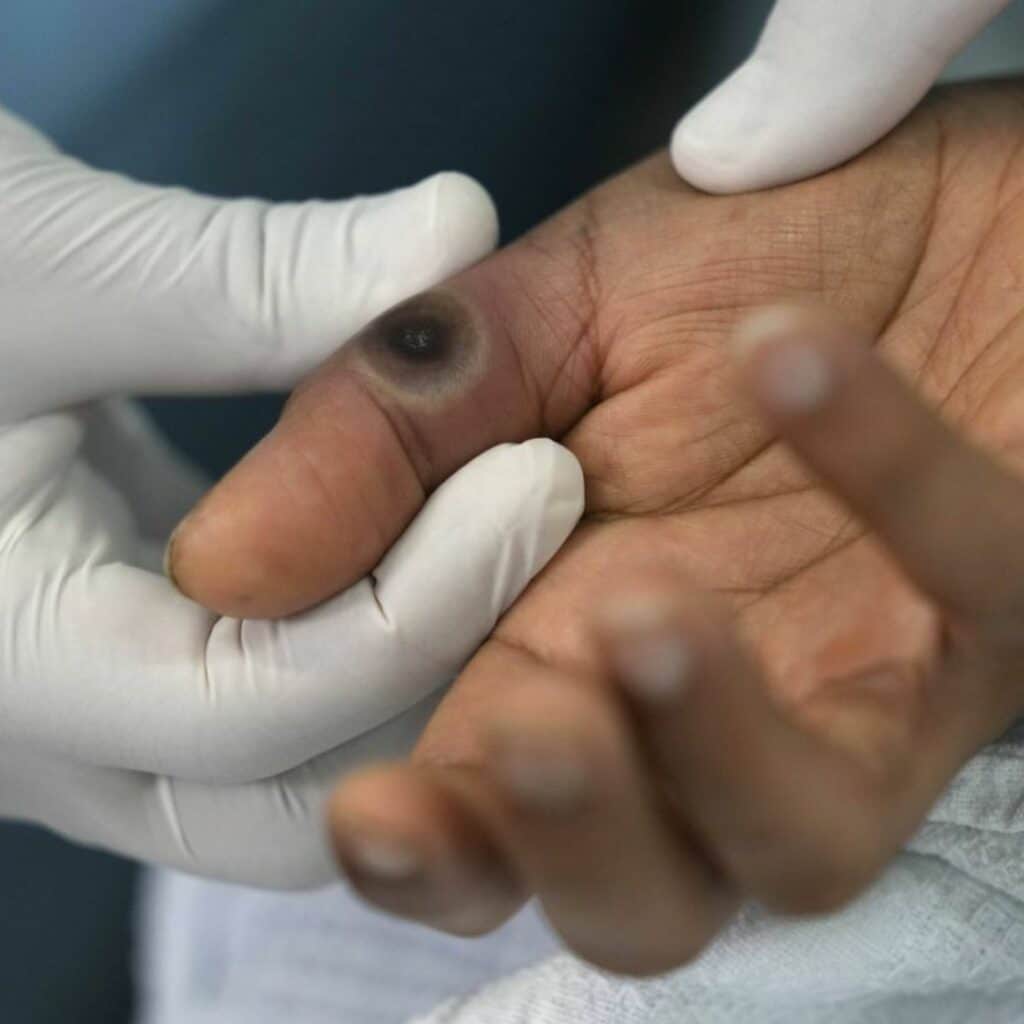 Variole du singe : l’arrivée en France est inévitable selon les experts