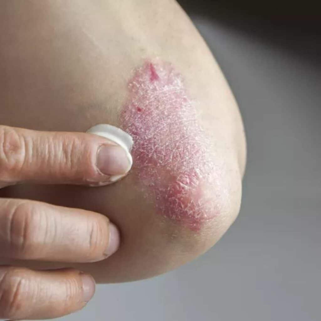 Psoriasis : la liste des aliments à éviter lorsqu’on est atteint de cette maladie chronique