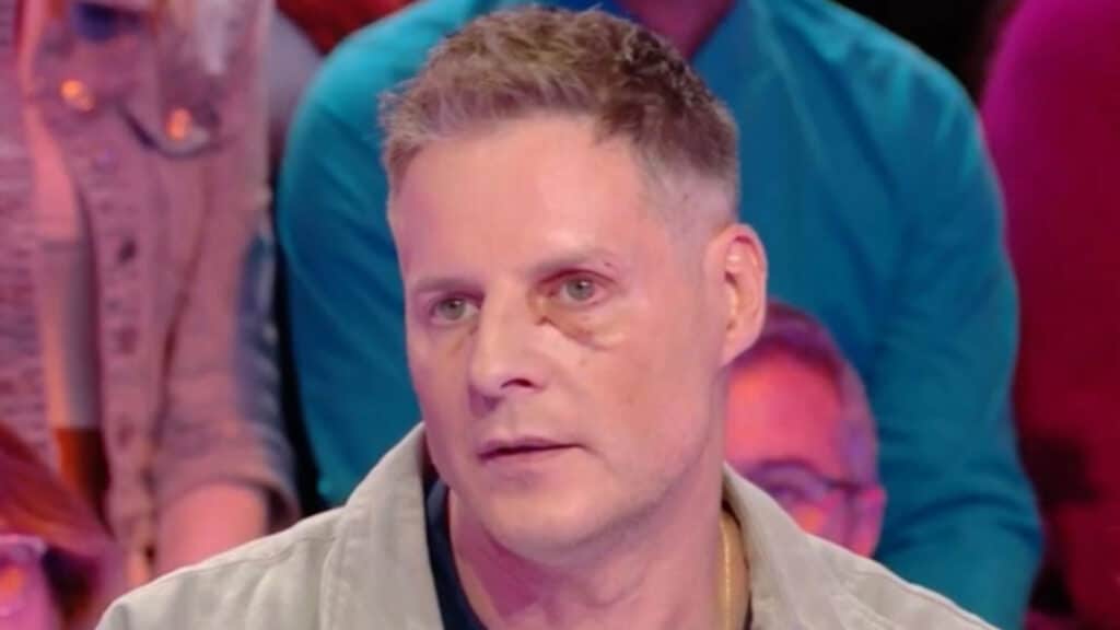Matthieu Delormeau : le visage amoché, il raconte son accident dans Tout beau tout 9