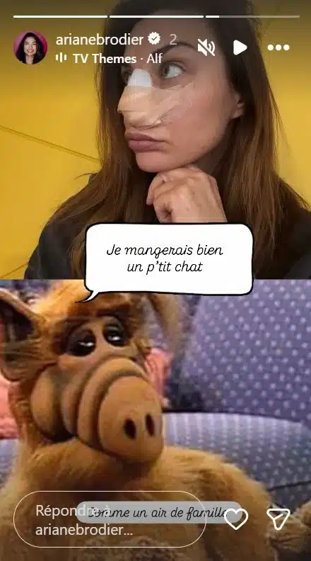 Ariane Brodier agressée : elle montre le résultat de son opération chirurgicale du nez